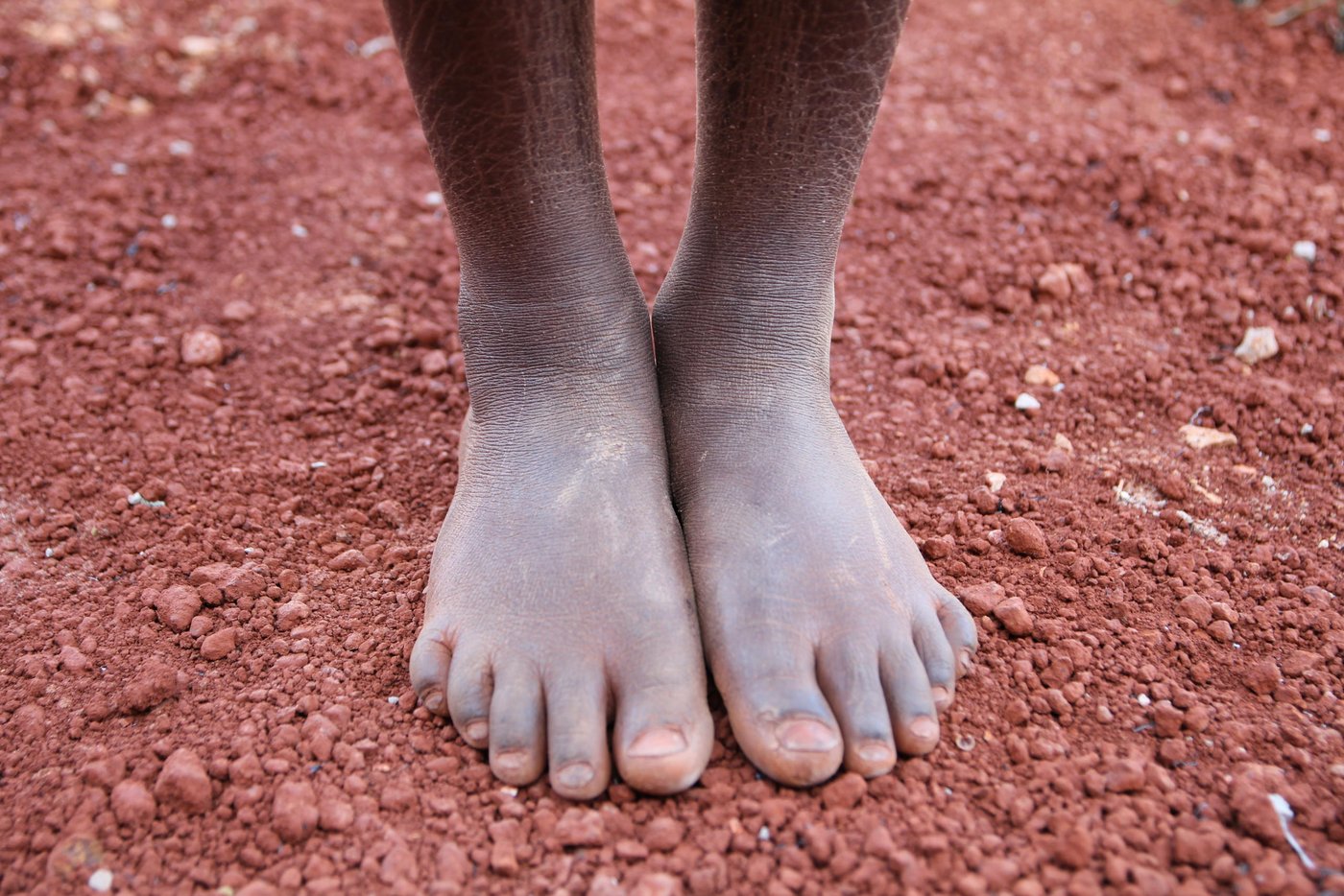 Diane (10), left Burundi while in Class Three at Kumwumi Primary School. However, while at the camp, Diane has not been able to resume school. She lacks the basic learning materials. “I do not have clothes, shoes, books, pen, ruler and a school bag,” she says. She walks bare-footed.
However, Diane is excited about the prospect of returning to class. She is one of the pupils who will start schooling at the primary school being constructed by NRC in Mtendeli.
Diane quotes (from June 2017 interview):
“In Burundi, I liked to study. I had materials: clothes, shoes, exercise books, rubber, pencil, mathematical set, pen, shoes and body lotion.”
“We had a charming teacher who made us laugh. The school was built well and I had a friend.”
“In Burundi, I had a friend. I miss my father. I miss my friend. I miss my teacher who made us laugh. I miss my home.”
“What made us flee was political warfare. People were killed, taken at night, we could not know where they had taken them. Even my father, they took him at night.”
“In Burundi because there was a selective war, I stopped school for one year. I see they are building schools here. I pray that I also study here.”
“In Burundi, I likes Mathematics, Kirundi. I want to teach. I want to become a teacher too.”
“At school in Burundi, I likes Mathematics, Kirundi. I want to study. I want to become a teacher too.”
“In school, I likes Mathematics, I liked Kirundi, I wanted to study very hard so that I become a teacher too.”
“I see they are building the school there. I am happy because they are building. I will also go to study there to get knowledge.”
“I am hoping I will also be taken to study at that school.”
“I am happy because I see they are building the school and I have been selected to study from that school.”
“Thank you for listening to my story.”
“I hope I will get teachers who will make me laugh like those that I had in Burundi. I hope I will get friends as those I had in Burundi.”
Lyrics of her song: “When Petro was still young, he saw other children going to school, he escorted them. On the way he turned back, while very sad, then he told his parents, to bring him to school. When he started school, he did not delay to finish, and now he succeeded, he is teaching other pupils. He is teaching other pupils.”
Photo: NRC/Ingrid Prestetun